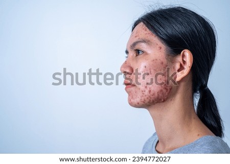 Acne on face because the disorders of sebaceous glands productions.  Acne or a Cosmetic Allergy. Hormonal changes and Foods Cause Symptoms of Skin Allergies 