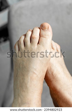 Nails of a 70-year-old woman with a defect of thickening on the foot after procedure podologist. Onychodystrophy. Onychauxis. Royalty-Free Stock Photo #2394802923