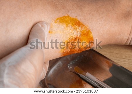 doctor treats large healing wound from on lower leg with scars of adult patient, inflammation and Medical Allergies, scarring skin, scald on female limb Royalty-Free Stock Photo #2395101837