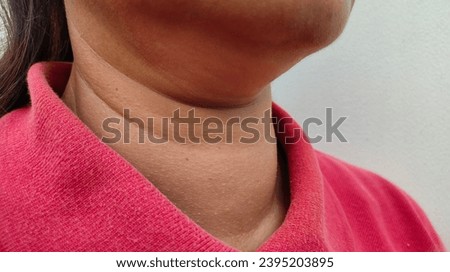 Big neck, Close-up of neck of Asian woman with swelling of the neck, thyroid disease, Dark, freckles skin, wearing red shirt, dry and rough skin, palpation and the concept of maintaining good health
