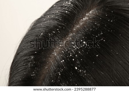 Woman with dandruff in her dark hair on white background, closeup