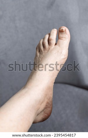 Nails of a 70-year-old woman with a defect of thickening on the foot. Onychodystrophy. Onychauxis. Royalty-Free Stock Photo #2395454817