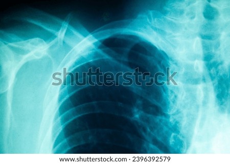 X-ray picture of shoulder and chest