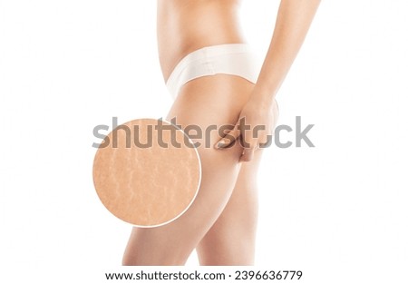 A woman after weight loss shows stretch marks on the skin of her legs and the outer and inner side of the thighs. Treatment of skin stretch marks in the clinic. Royalty-Free Stock Photo #2396636779
