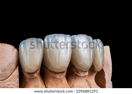 Emax crowns and veneers like natural color Royalty-Free Stock Photo #2396881291