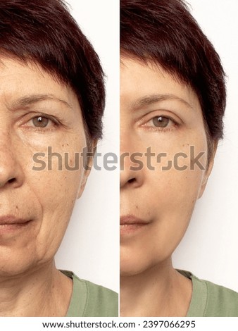 Close-up of an elderly woman's face before and after a facelift. Rejuvenation procedure, Botox. Blepharoplasty, removal of wrinkles, puffiness, creases and bags under the eyes. Plastic surgery. Beauty Royalty-Free Stock Photo #2397066295