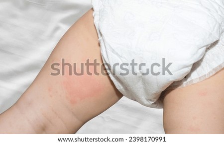 irritation on the skin of the baby from the diaper close-up and Baby with a rash Royalty-Free Stock Photo #2398170991