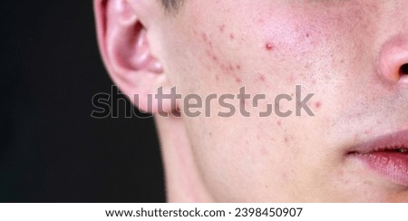 Man with pimples on skin. Acne and pimple on skin. Dermatology, puberty man. Pimples problem. Young Man with Pimple on face. Care skin, Pimples problem. Guy Pimple face, close up. Royalty-Free Stock Photo #2398450907
