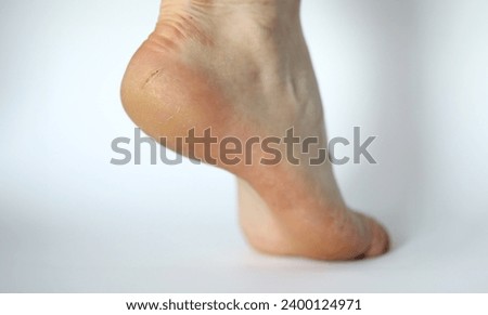 Close-up of dry leg covered with painful callous. Female heel shown in modern photography studio to expose illness. Moisturizing cream advertisement concept. Isolated on white background