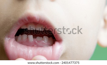 Close up, boy opens his mouth and shows his milky teeth. One missing tooth replaced with permanent toot. . High quality photo