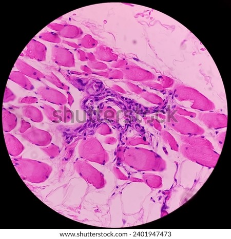 Microscopic image of above knee amputation. Section show fibro collagenous tissue, fatty tissue, skeletal muscles with inflammatory cells. Bony soft tissue resection margin. Bone cancer. Royalty-Free Stock Photo #2401947473