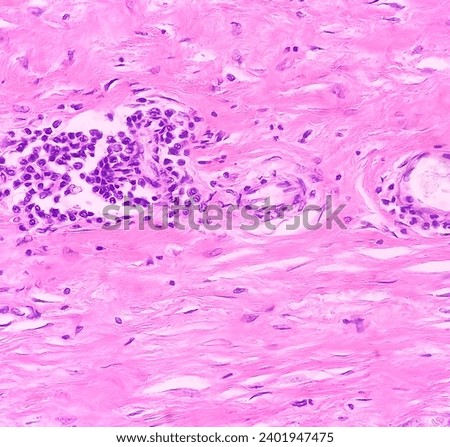 Microscopic image of above knee amputation. Section show fibro collagenous tissue, fatty tissue, skeletal muscles with inflammatory cells. Bony soft tissue resection margin. Bone cancer. Royalty-Free Stock Photo #2401947475