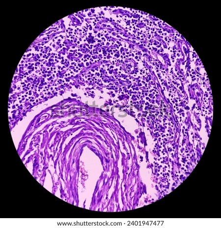 Microscopic image of above knee amputation. Section show fibro collagenous tissue, fatty tissue, skeletal muscles with inflammatory cells. Bony soft tissue resection margin. Bone cancer. Royalty-Free Stock Photo #2401947477