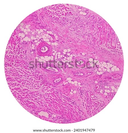 Microscopic image of above knee amputation. Section show fibro collagenous tissue, fatty tissue, skeletal muscles with inflammatory cells. Bony soft tissue resection margin. Bone cancer. Royalty-Free Stock Photo #2401947479