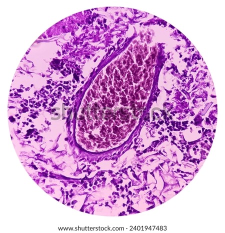 Microscopic image of above knee amputation. Section show fibro collagenous tissue, fatty tissue, skeletal muscles with inflammatory cells. Bony soft tissue resection margin. Bone cancer. Royalty-Free Stock Photo #2401947483
