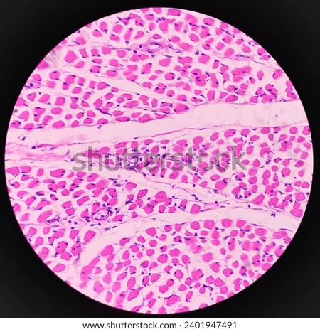 Microscopic image of above knee amputation. Section show fibro collagenous tissue, fatty tissue, skeletal muscles with inflammatory cells. Bony soft tissue resection margin. Bone cancer. Royalty-Free Stock Photo #2401947491