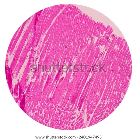 Microscopic image of above knee amputation. Section show fibro collagenous tissue, fatty tissue, skeletal muscles with inflammatory cells. Bony soft tissue resection margin. Bone cancer. Royalty-Free Stock Photo #2401947495