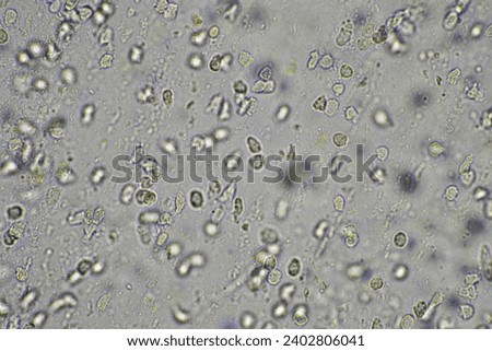 Coughing up mucus and phlegm from a chest infection from a virus and bacteria infection, looking at it under the microscope, with cells and microorganisms. Bacteria and skin cells Royalty-Free Stock Photo #2402806041