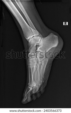 Normal radiography, xray or x-ray of the foot and ankle joint in lateral projection, traumatology and orthopedics, rheumatology Royalty-Free Stock Photo #2403566373