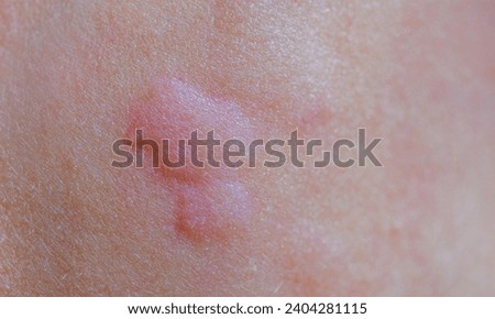 Close up image of skin texture suffering severe urticaria or hives or kaligata . Allergy symptoms. Royalty-Free Stock Photo #2404281115