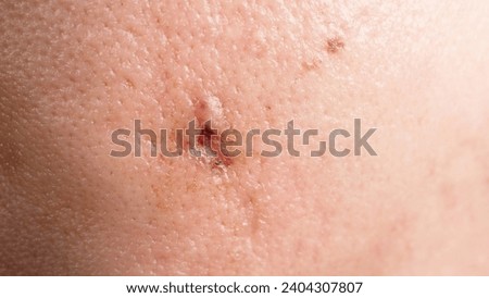 Scars from facial abscess or big acne surgery.  Scars from inflammation of the skin after medical treatment.  Close up scars or problem skin on face. Photo after treatment for big abscess and acne.
