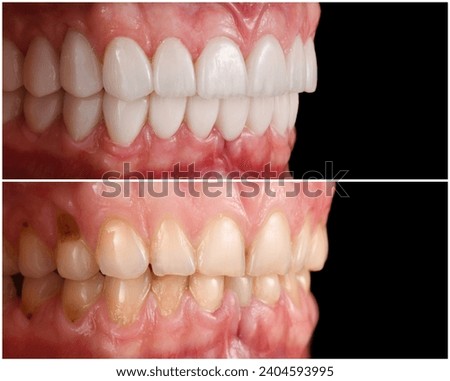new created dental smile by ceramic veneers Royalty-Free Stock Photo #2404593995
