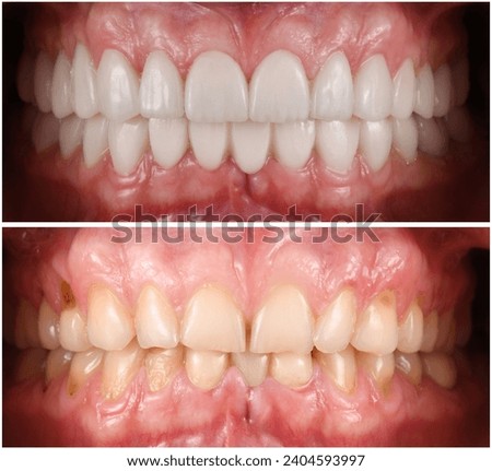 new created dental smile by ceramic veneers Royalty-Free Stock Photo #2404593997