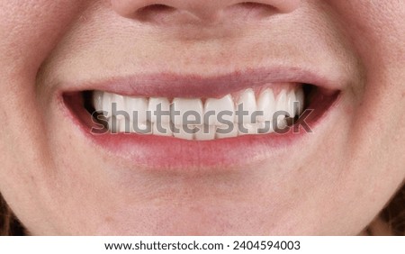 new created dental smile by ceramic veneers Royalty-Free Stock Photo #2404594003