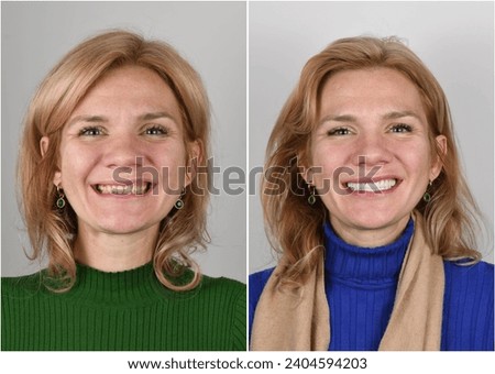 new created dental smile by ceramic veneers Royalty-Free Stock Photo #2404594203