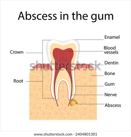 medical infographic template and tooth anatomy.abscess