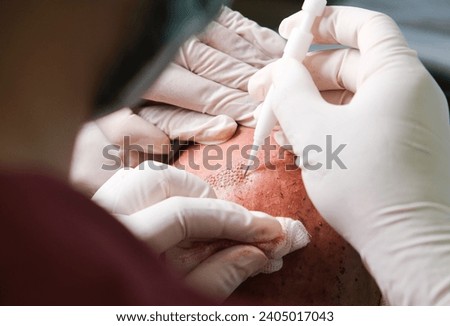Hair transplant surgery with dhı pencil in close-up. The hands of the doctor performing the hair transplant and the patient's scalp. Royalty-Free Stock Photo #2405017043