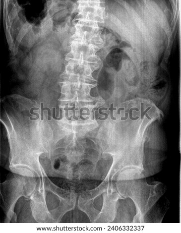 Film x ray or radiograph of an adult lumbar vertebrae anterior posterior AP view showing a very large osteophyte bone spur on L4 L5 right side transverse process of elderly patient