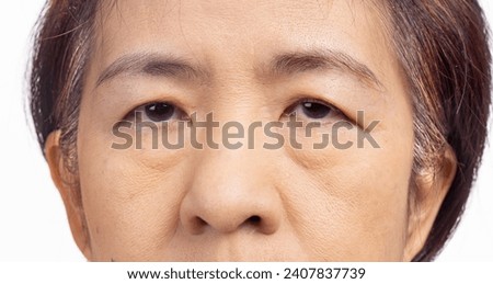 The ptosis or droopy eyelids in asian senior woman. Royalty-Free Stock Photo #2407837739