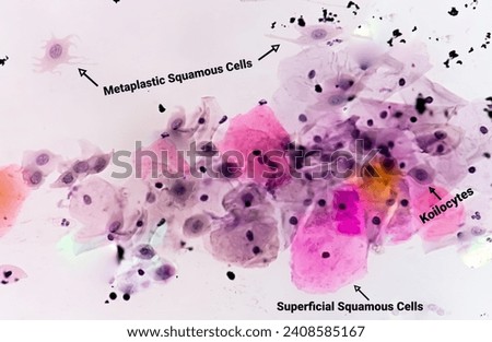 Paps smear analysis: Superficial squamous cell, metaplastic squamous cell, koilocytes cell. HPV related change Royalty-Free Stock Photo #2408585167