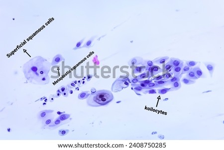 Paps smear analysis: Superficial squamous cell, metaplastic squamous cell, koilocytes cell. HPV related change Royalty-Free Stock Photo #2408750285