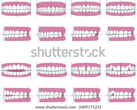 Types of tooth alignment and malocclusion. Front and side vector illustration Royalty-Free Stock Photo #2409171231