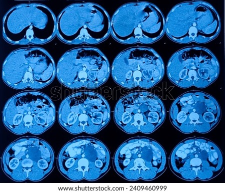 CT (computerized tomography) urogram. Spindle cell tumor of left testis, postoperative state, cystic lesion at left lumbar region, mesenteric or enterogenous cyst with hydro-uretero-nephrosis. Royalty-Free Stock Photo #2409460999