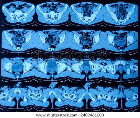 CT (computerized tomography) urogram. Spindle cell tumor of left testis, postoperative state, cystic lesion at left lumbar region, mesenteric or enterogenous cyst with hydro-uretero-nephrosis. Royalty-Free Stock Photo #2409461003