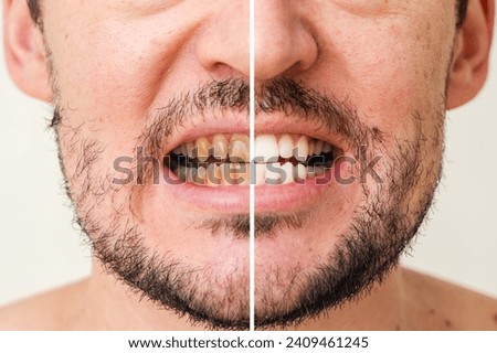 The man's teeth before and after whitening and alignment (braces). Oral care