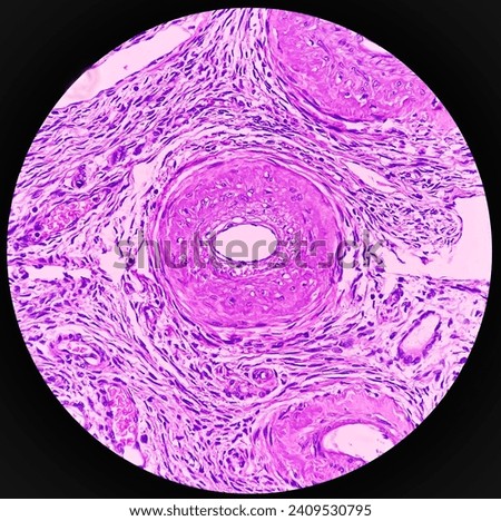Uterus with adnexa (biopsy): Cervix show chronic inflamatory cells, wall show secretory phase in endometrium and fallopian tube show paratubal cyst. fimbrial cyst, Paraovarian cyst. Royalty-Free Stock Photo #2409530795