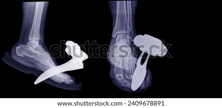 X-ray image of a foot with a metal piercing on the sole of the foot Shows the front and sides.
