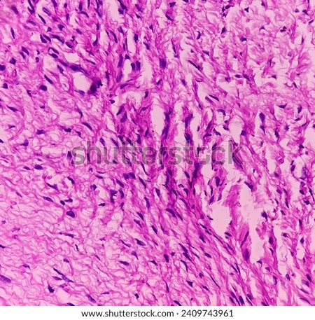 Fibromyxoma. Leg tissue biopsy: Sections microscopically show features of fibromyxoma. Superficial Acral Fibromyxoma, rare slow growing myxoid tumor. Royalty-Free Stock Photo #2409743961