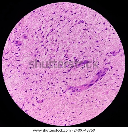 Fibromyxoma. Leg tissue biopsy: Sections microscopically show features of fibromyxoma. Superficial Acral Fibromyxoma, rare slow growing myxoid tumor. Royalty-Free Stock Photo #2409743969