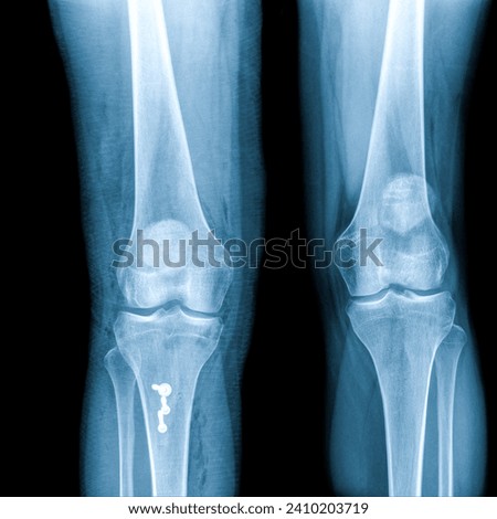 X-ray Knee Joint Fracture proximal tibia and Post fix fracture proximal tibia with plate and screws.Normal joint space.Minimal joint effusion Royalty-Free Stock Photo #2410203719