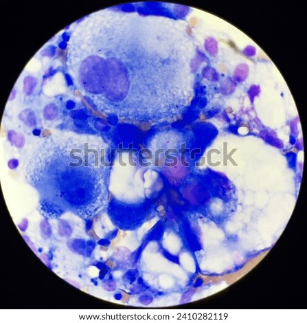 Abnormal cells in body fluids. Royalty-Free Stock Photo #2410282119