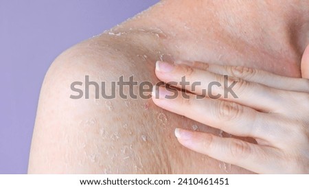 Problematic dry skin on shoulder close-up front view flaking as consequence of dry skin dehydration and dermatitis, concept of health problem dry skin and personal hygiene self care Royalty-Free Stock Photo #2410461451