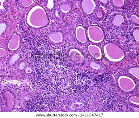 Light micrograph of a human thyroid with chronic thyroiditis (Hashimoto disease). There are extensive chronic inflammatory infiltrates and lymphoid follicles with germinal centres. Royalty-Free Stock Photo #2410547417