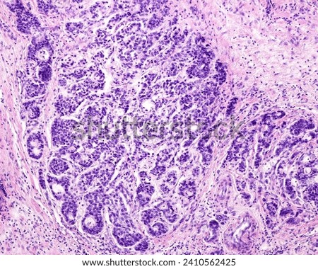 Human prostate cancer (adenocarcinoma). The cancerous cells form solid sheets of cells without barely forming glands. This is considered a high-grade type of pattern that carries a worse prognosis Royalty-Free Stock Photo #2410562425