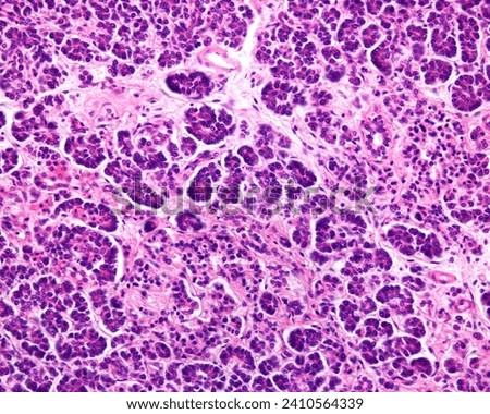 Human pancreas. Islet of Langerhans with a drastic reduction of endocrine cells and pink hyalinization (with deposition of amyloid). This change is common in patients with type II diabetes mellitus Royalty-Free Stock Photo #2410564339