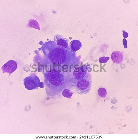Ascitic fluid cytology. Leishman stain smear show Lymphocytes, polymorphs cells. Abnormal cells. Ascites. Royalty-Free Stock Photo #2411167539